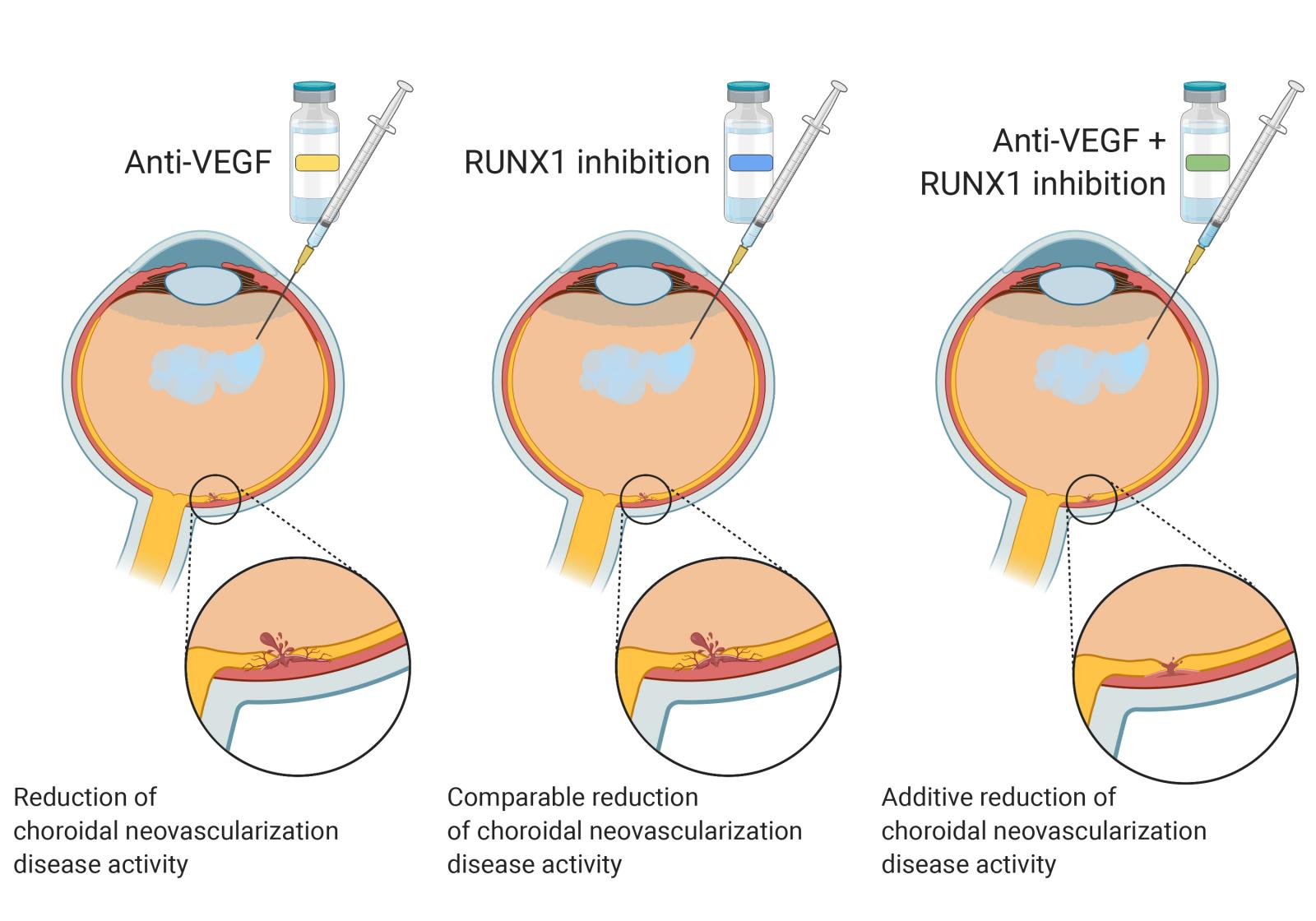 Schematic showing reduction of neovascularization with injection of both anti-VEGF and RUNX1 inhibitor