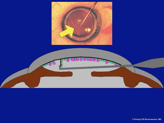 Schematic showing how Deschemet's membrane and endothelium are stripped during surgery