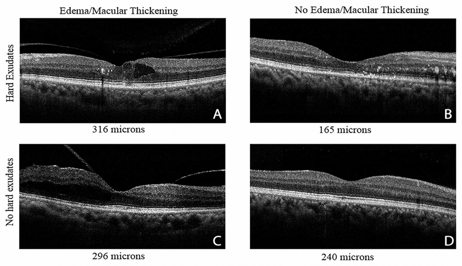 Four OCT images showing slices through retinas with diabetic eye disease