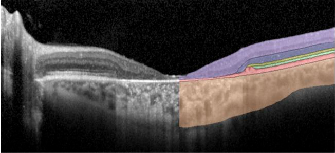 OCT image with colored segmented retinal layers.