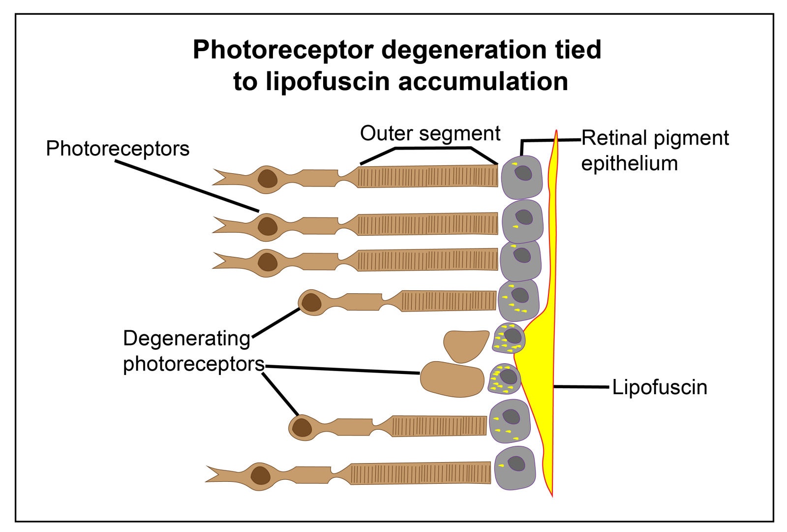 Photoreceptor degeneration tied to lipofuscin accumulation.