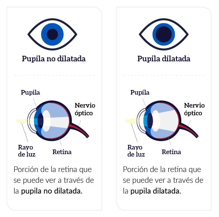 Una pupila dilatada y una no dilatada. Un rayo de luz delgado entra en el ojo a través de una pupila no dilatada y brilla en una parte pequeña de la retina en la parte de atrás del ojo. Un rayo de luz más ancho entra a través de una pupila dilatada y brilla en una parte más grande de la retina.