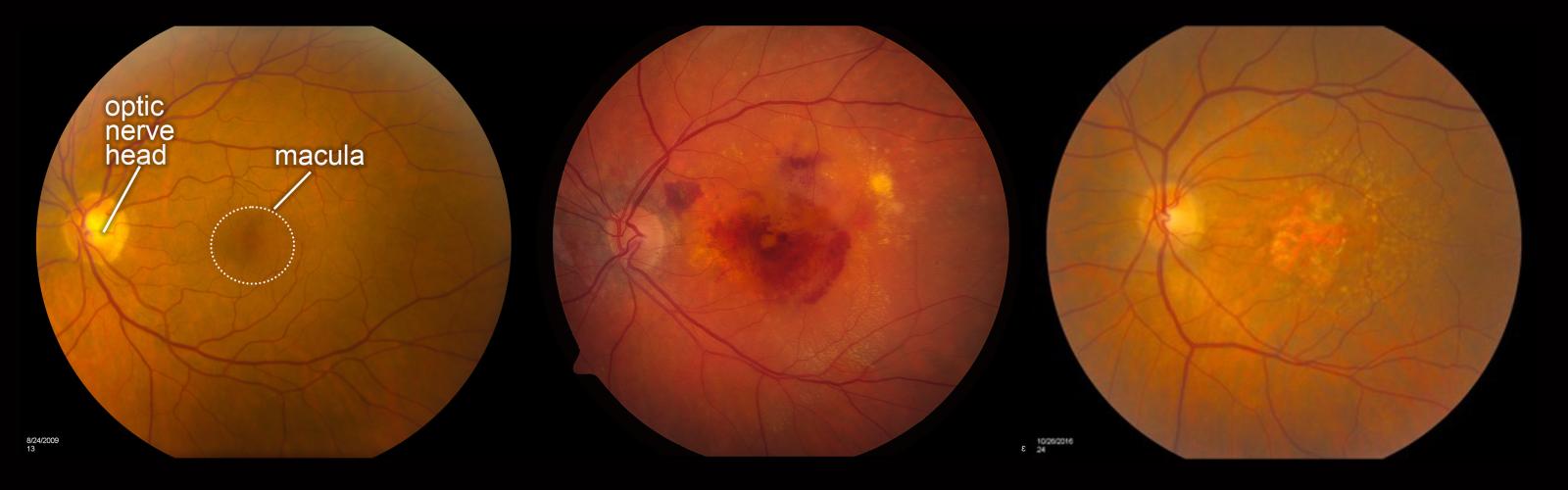 Fundus photos