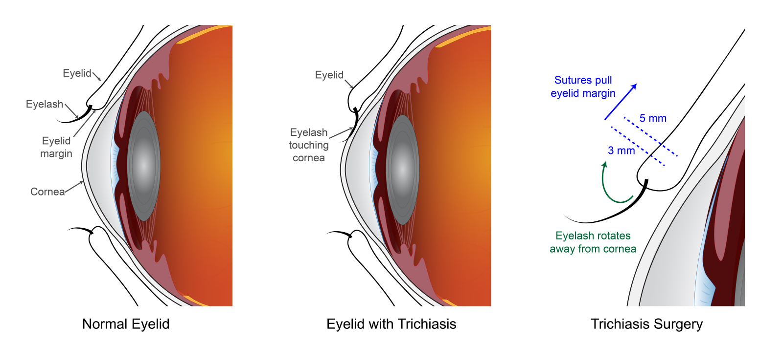 Schematic of trichiasis surgery.
