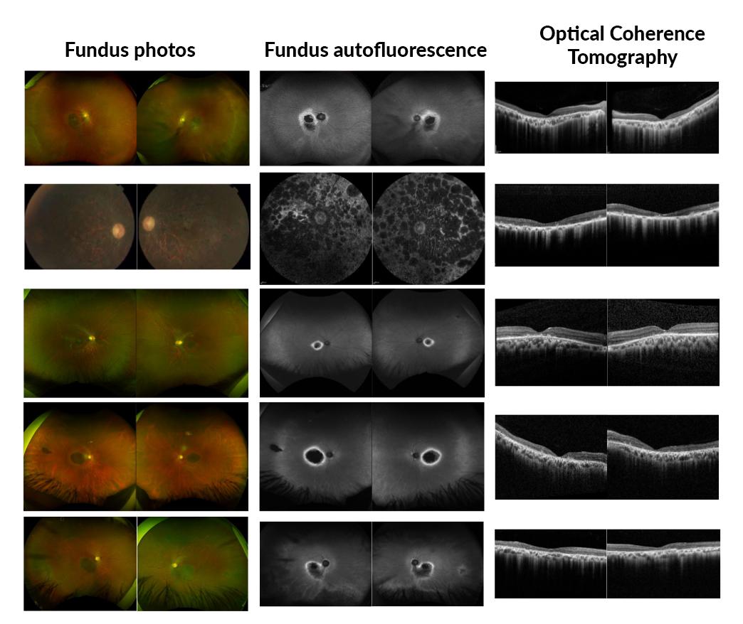 Ophthalmic images from the study probands exhibit variable forms of retinal dystrophy as shown on fundus photos, fundus autoflorescence and optical coherence tomography.