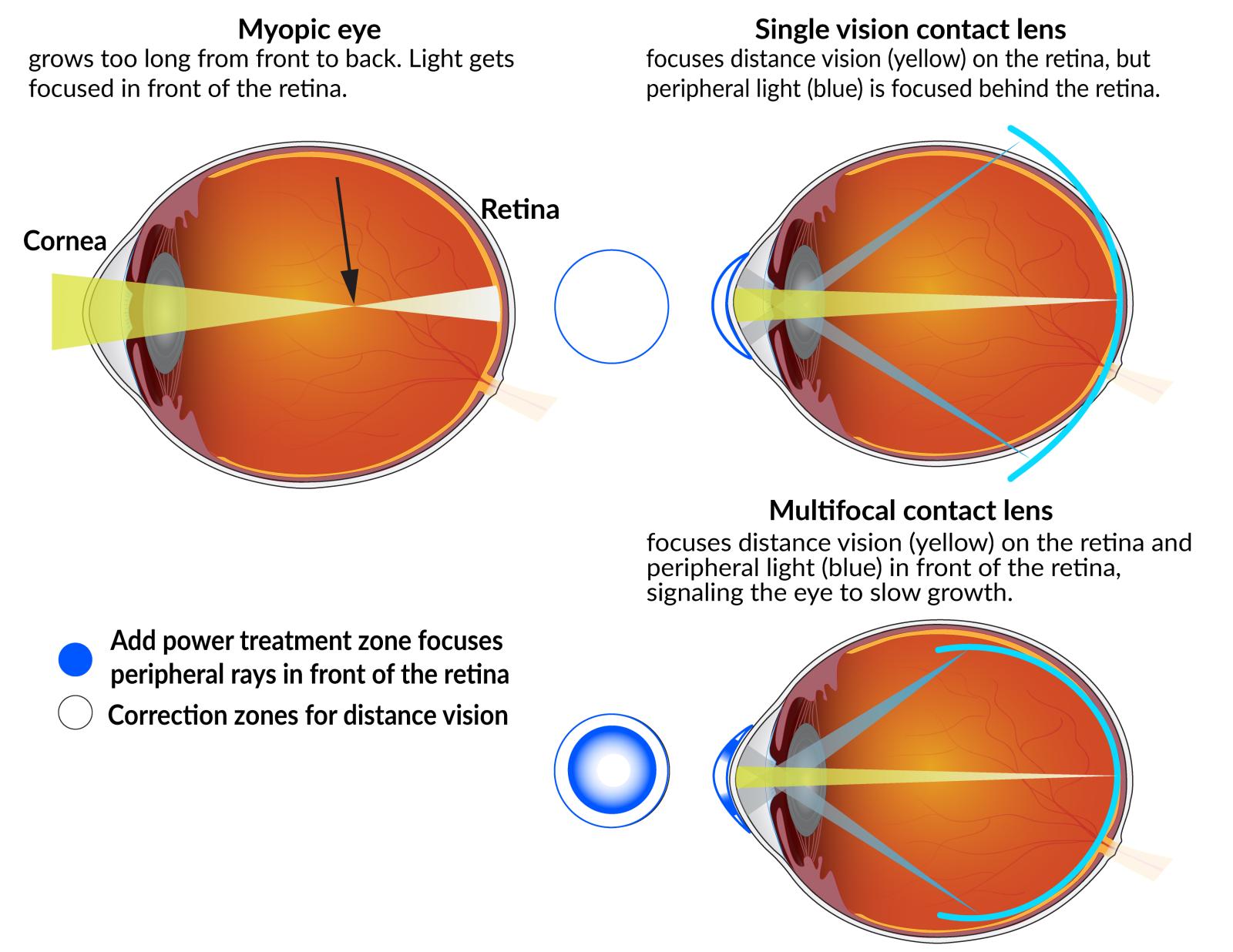 A myopic eye grows too long from front to back. Light gets focused in front of the retina. Single-vision contact lenses focus distance vision on the retina, but peripheral light is focused behind the retina. Multifocal contact lenses focus distance vision on the retina and peripheral light in front of the retina, signaling the eye to slow growth.Multifocal contact lenses are concentric circles consisting of an add power treatment zone in the outer rings that focuses peripheral rays in front of the retina.