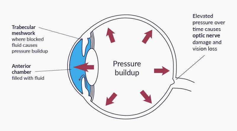A diagram of the eye with red arrows showing how fluid in the anterior chamber can get blocked by the trabecular meshwork, causing pressure buildup.