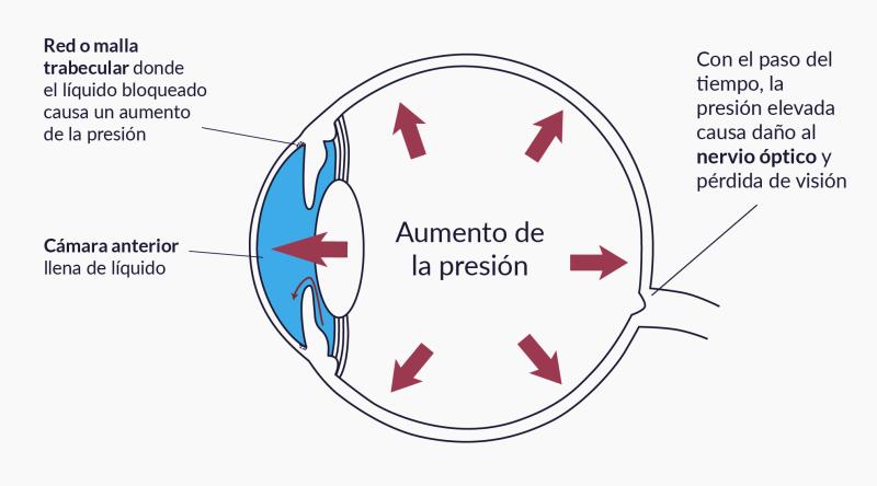 Diagrama del ojo con flechas rojas mostrando como el líquido en la cámara anterior puede ser bloqueado por la malla trabecular causando aumento de presión.