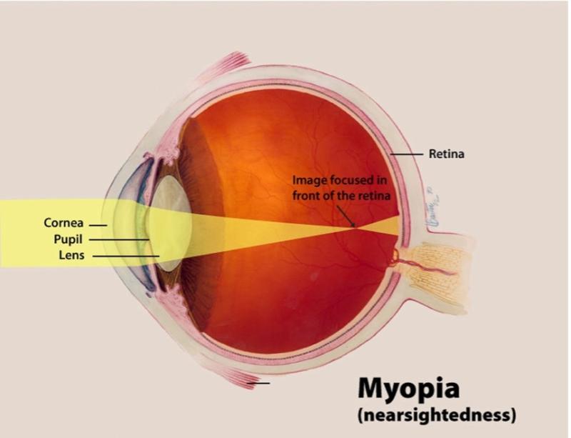 Graphic of an eye showing how myopia happens 