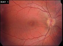 Fundus photo 