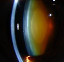 Brunescent nuclear cataract