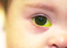 A child wearing a contact lens. A green dye is used to evaluate the fit of hard lenses. 