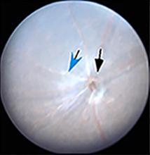Eyes with autoimmune uveitis show increased inflammatory cells in the eye (indicated by arrows). Treatment with p35 reduces this inflammatory response.  Credit: Charles Egwuagu.