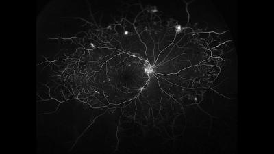 Blood vessels in the retina