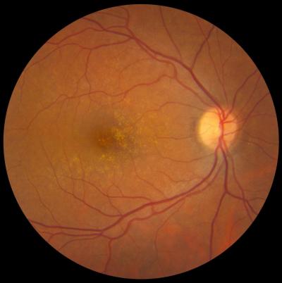 Fundus photo showing medium drusen