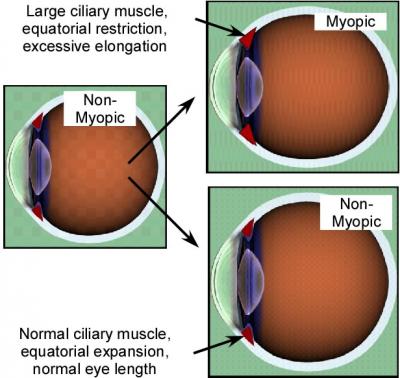 Diagram showing transition from non-myopic to myopic eye during growth, with large ciliary muscle and extra elongation