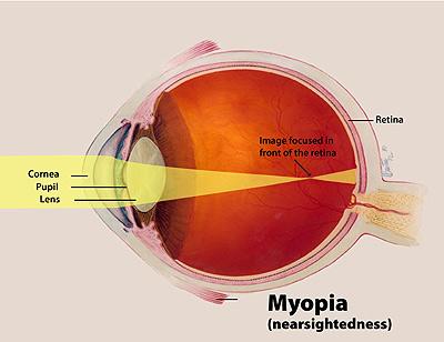 Diagram of myopic eye stretched front-to-back showing light focused in front of the retina