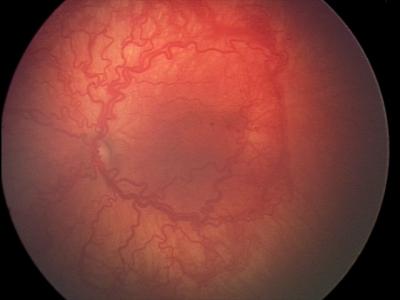 Severe ROP Avastin candidate