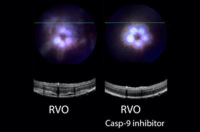 Eye scans showing retinal vein occlusion with and without Casp-9 inhibitor
