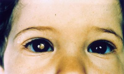 Photo of child with one white pupil, a sign of retinoblastoma