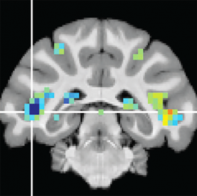 Slice of brain scan showing highlights in the cortex