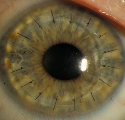 Closeup image of eye with sutures