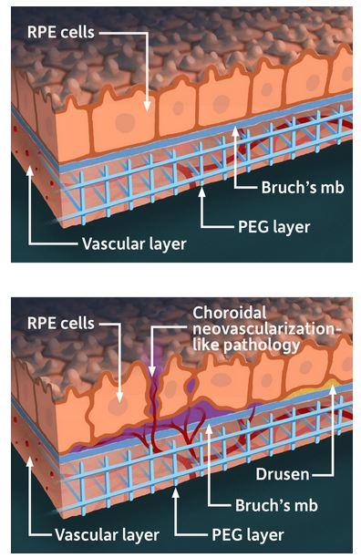 3D models of retina shown. Top shows normal retina, bottom shows retina affected by AMD.