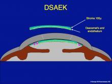 Graphic showing thickness of stroma