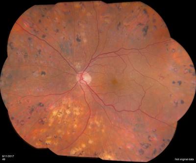 retina