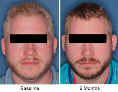 Side-by-side photos of trial participant before and after treatment