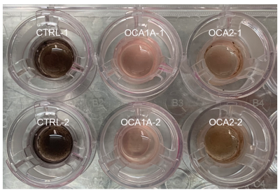 Picture of circular wells with darker circles to the left and lighter circles to the right representing control and patient models of albinism.