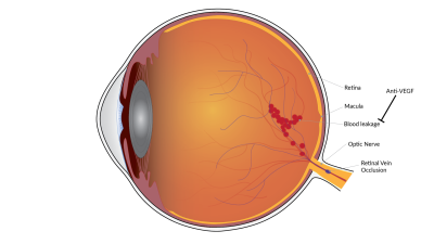 Schematic shows blood vessel leakage on side of retina