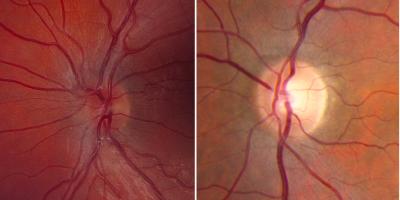 Comparison of two retinal images. 