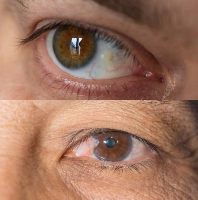 Images of eyes with pinguecula and pterygium. Source: American Optometric Association
