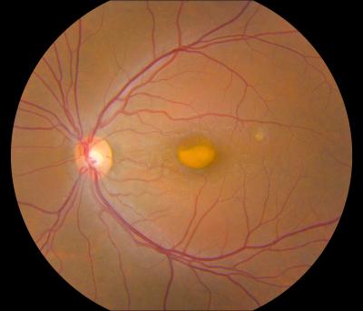 Retina
