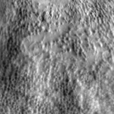 Anteriorly-displaced cone photoreceptors imaged in a patient with vitelliform macular dystrophy