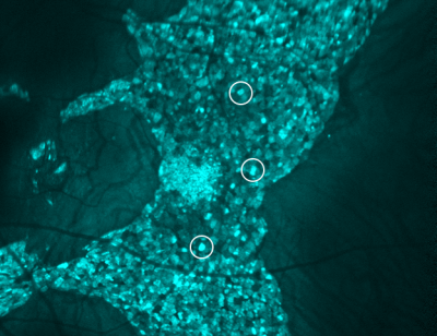 Image of enlarged RPE cells in patient with choroideremia
