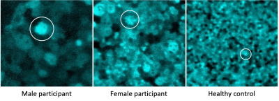 Three images of eyes with choroideremia showing enlarged RPE cells