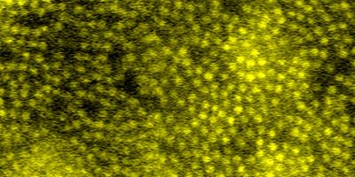 Cone photoreceptors fluorescently labeled with indocyanine green dye in a female carrier of choroideremia.
