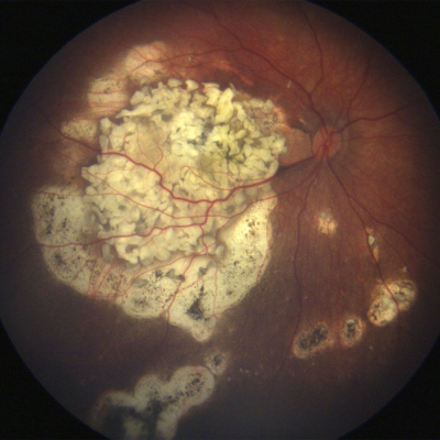 Fundus photo showing large white patches