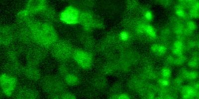 Enlarged retinal pigment epithelial cells (left half of image) labeled with indocyanine green dye in a patient with choroideremia.