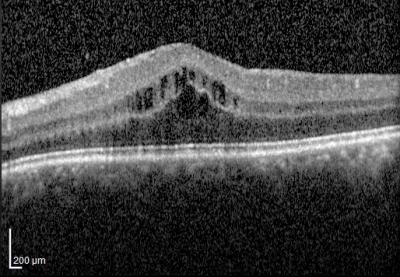 Retinal OCT showing fluid pocket in the macula