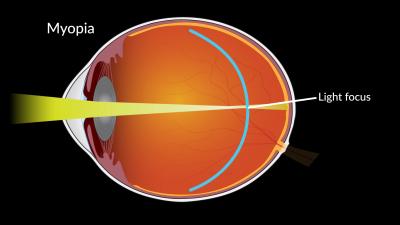 illustration showing axial elongation of the eye from myopia