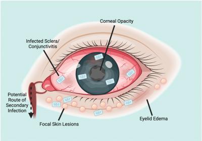 illustration showing ocular manifestations of mpox, including conjunctivitis, rout of secondary infection, focal skin lesions, eyelid edema, and corneal opacity. 