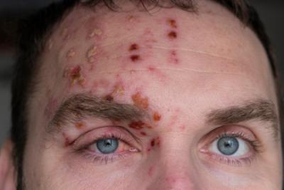 Man with shingles around his eye
