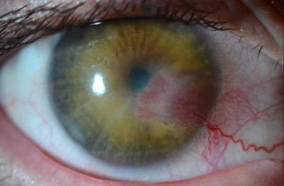 eye with herpes stromal keratitis