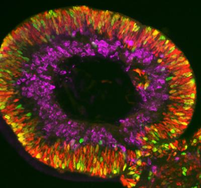 Retina organoids mimic the structure and function of the human retina to serve as a platform to study underlying causes of retinal diseases, test new drug therapies, and provide a source of cells for transplantation. credit: David Gamm, M.D., Ph.D., University of Wisconsin-Madison