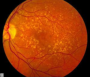 Fundus photograph of age-related macular degeneration showing drusen.