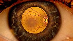 Illustration showing the retina as seen through a dilated pupil.