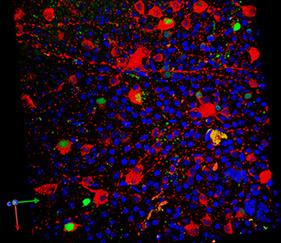 Dr. John Guy and colleagues added a homing signal to a virus in order to deliver the ND4 gene into mitochondria. A marker for the gene is shown in red and the ND4 protein is shown in green, inside retinal ganglion cells in the mouse eye. The nuclei of retinal ganglion cells are shown in blue. Credit: Dr. Hong Yu, Bascom Palmer.
